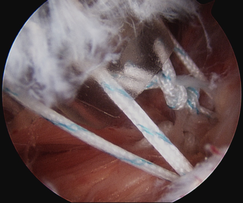 Remplissage Subacromial Knots